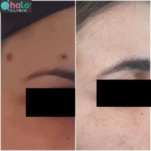 לפני ואחרי הסרת נקודת חן בפנים באמצעות לייזר – תמונה אמיתית של לקוחה לאחר החלמה