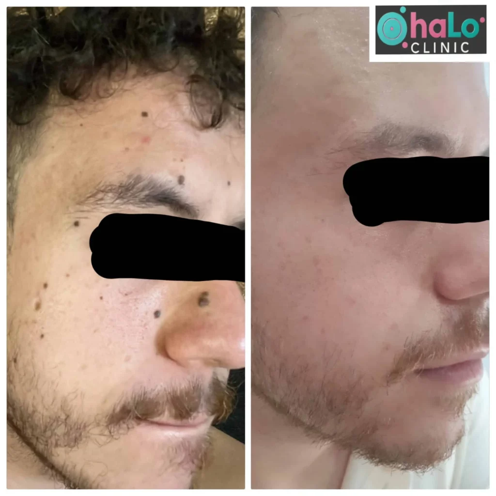 לפני ואחרי הסרת נקודות חן מהפנים בלייזר ב-Halo Clinic