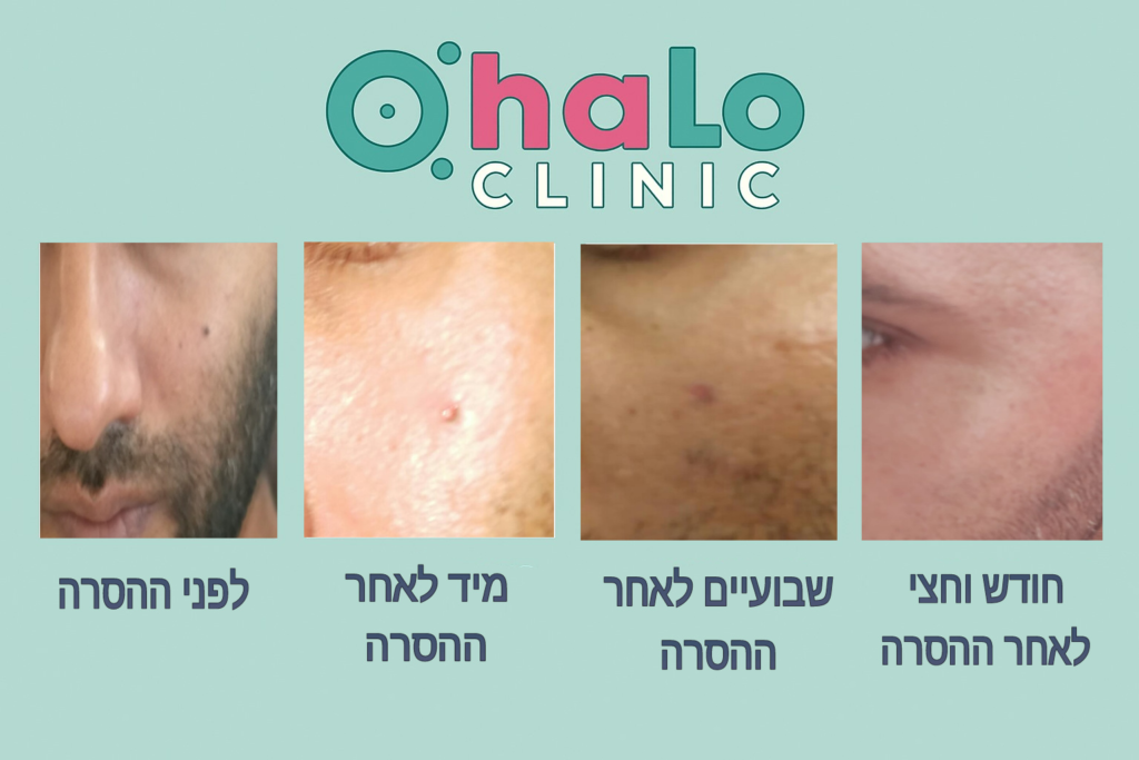 שלבי החלמה לאחר הסרת נקודת חן בפנים בלייזר – לפני ואחרי הטיפול ב-Halo Clinic